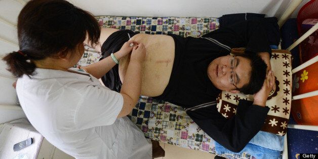 This picture taken on June 14, 2012 shows an overweight Chinese patient receiving acupuncture treatment at the Aimin (Love the People) Fat Reduction Hospital in the northern port city of Tianjin. Obesity is a relatively recent problem in China and a recent report by the Chinese Association for Student Nutrition and Health said the number of overweight young people aged between seven and 17 had tripled between 1982 and 2002, a trend that had accelerated in recent years. AFP PHOTO/Mark RALSTON (Photo credit should read MARK RALSTON/AFP/GettyImages)