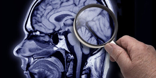 MRI image of brain showing area of Alzheimer patient.