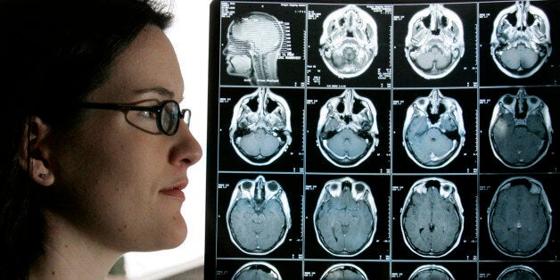 Kyla Nagel stands next to her brain scan at her home Friday, Jan. 28, 2005, in Springfield, Ore. Nagel was diagnosed with an