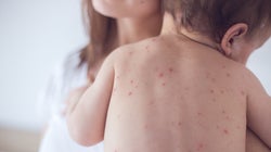 Le pire épidémie de rougeole aux États-Unis depuis