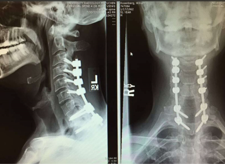 An X-ray of Rosenberg's injury.