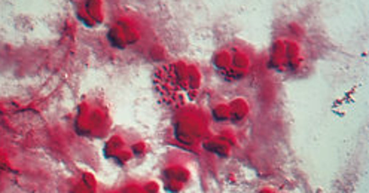 Scientists May Have Found Drug Combination To Treat SuperGonorrhoea Scientists May Have Found Drug Combination To Treat SuperGonorrhoea