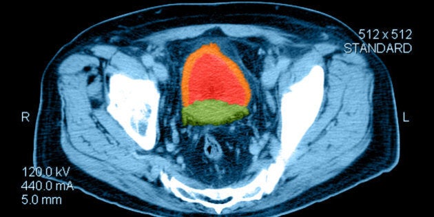 Color enhanced axial (cross sectional) CT image through the pelvis in a person with prostate cancer. Shown is an enlarged prostate (green) secondary to cancer and thickening of the bladder wall (orange) consistent with bladder out obstruction from the enla
