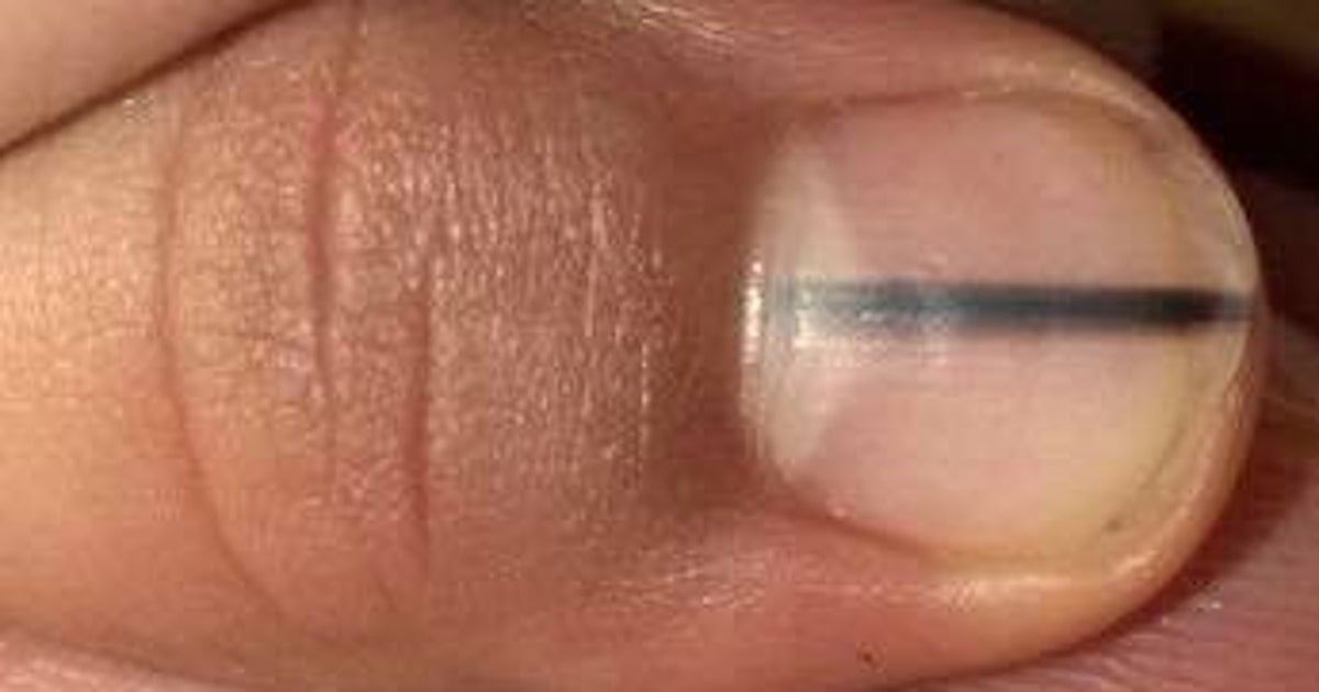 yellow-nail-syndrome-causes-symptoms-and-treatment