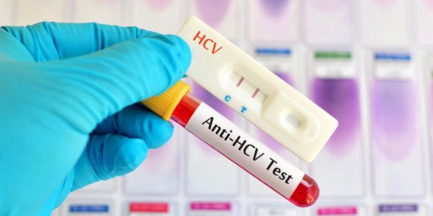 Hepatitis C virus (HCV) testing by using test cassette, the result showed positive (double red line)