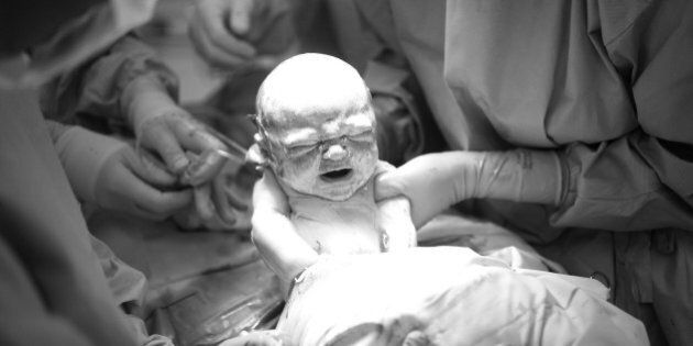 A baby being born by Caesarean Section. Childbirth,