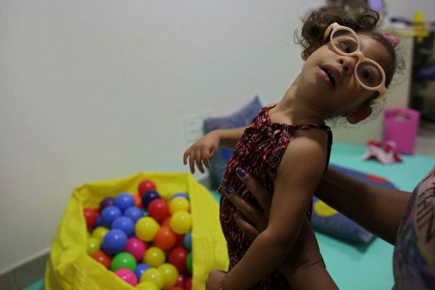 Agata da Silva, deux ans, est née avec une microcéphalie causée par une infection à virus Zika.