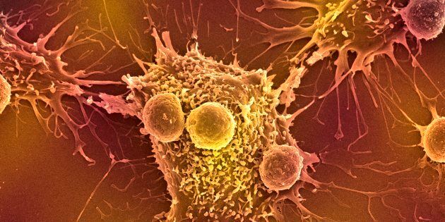 Lorsqu'une cellule devient cancéreuse, elle accumule des altérations dans son ADN qui, traduites en protéines, vont pouvoir générer ces fameux fragments anormaux que l'on appelle aussi antigènes spécifiques aux tumeurs.