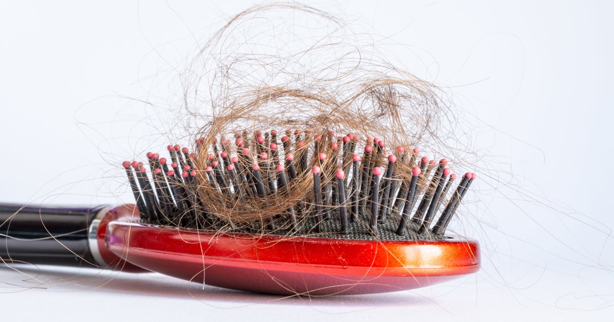 Pourquoi estce que je perds mes cheveux? HuffPost Vivre
