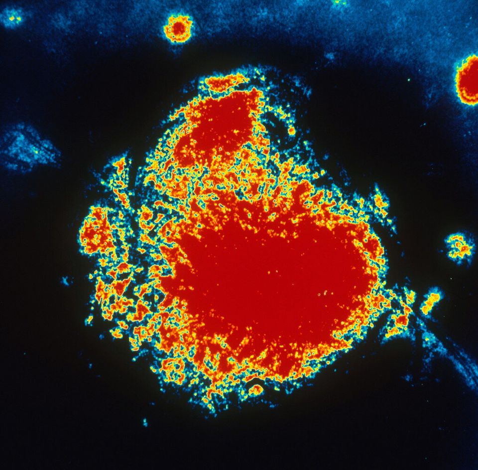 Un cancer guéri par une dose massive de virus modifiés de la rougeole