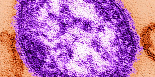 UNDATED: In this handout from the Centers for Disease Control and Prevention (CDC), a thin-section transmission electron micrograph (TEM) reveales the ultrastructural appearance of a single virus particle, or 'virion', of measles virus. in this undated image. Measles outbreaks have been reported throughout the U.S., with the latest reported February 5, 2015 at a daycare in suburban Chicago where as many as five children under the age of one have been infected. (Photo by CDC via Getty Images)