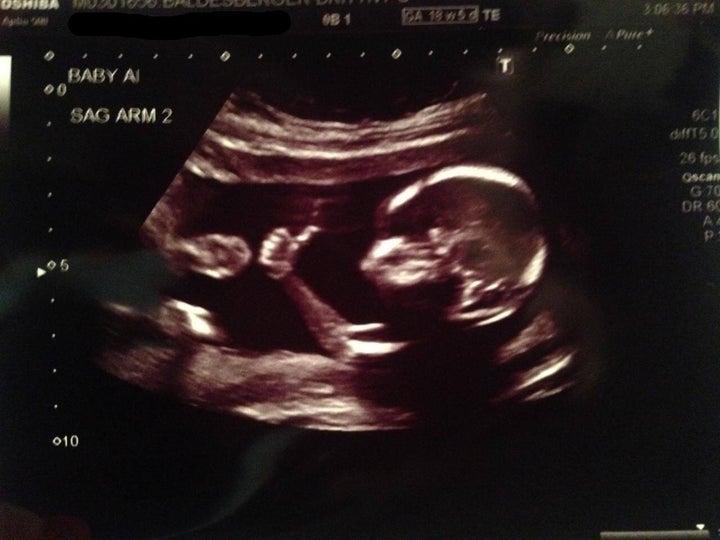 Ce Foetus A Le Pouce Leve Lors De L Echographie Photo Huffpost Null Ce Foetus A Le Pouce Leve Lors De L Echographie Photo Huffpost Null