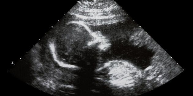 ultrasound image of 4 months...
