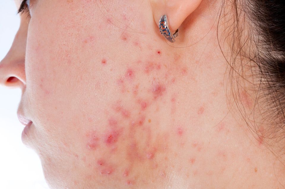 L'acné (incluant les points blancs)
