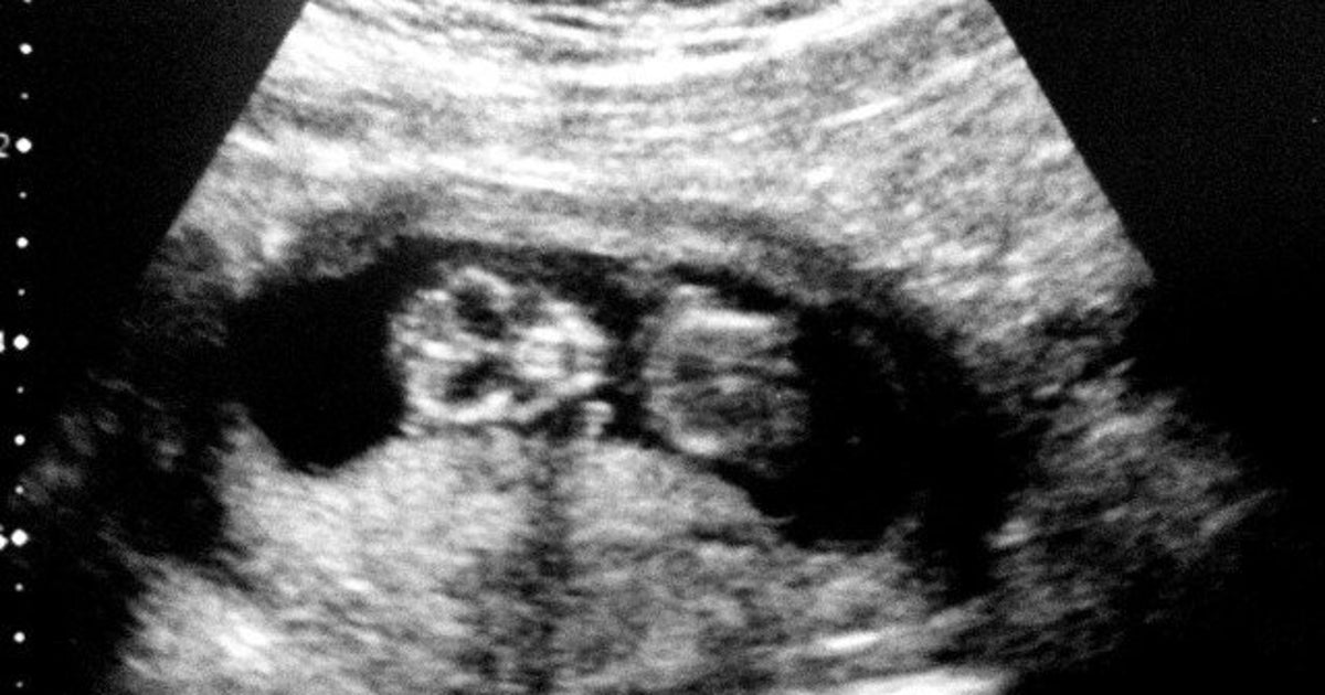 Battement Coeur Bébé 160 Fille Ou Garçon