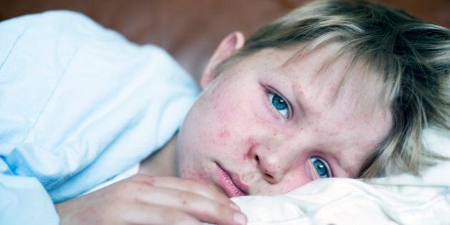 Very sick 5 year old little boy fighting measles infection, boy is laying in bed under the blanket with a agonizing expression, boy is covered with rash caused by virus.