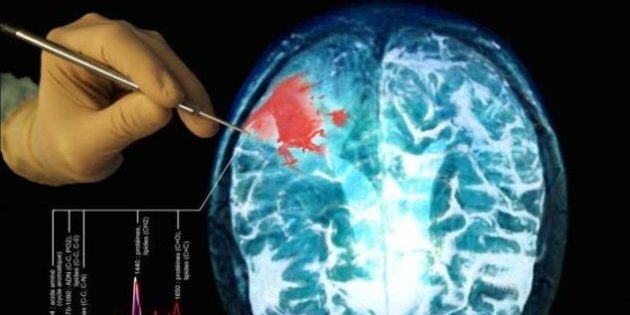 Représentation du travail de la sonde détectant des cellules cancéreuses au cerveau.