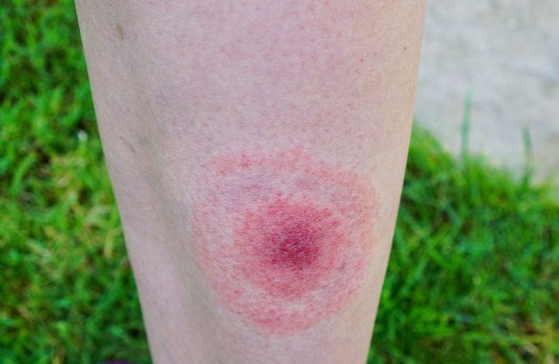 L'irruption cutanée concentrique est l'un des symptômes les plus facilement reconnaissables de l'infection liée à la maladie de Lyme.
