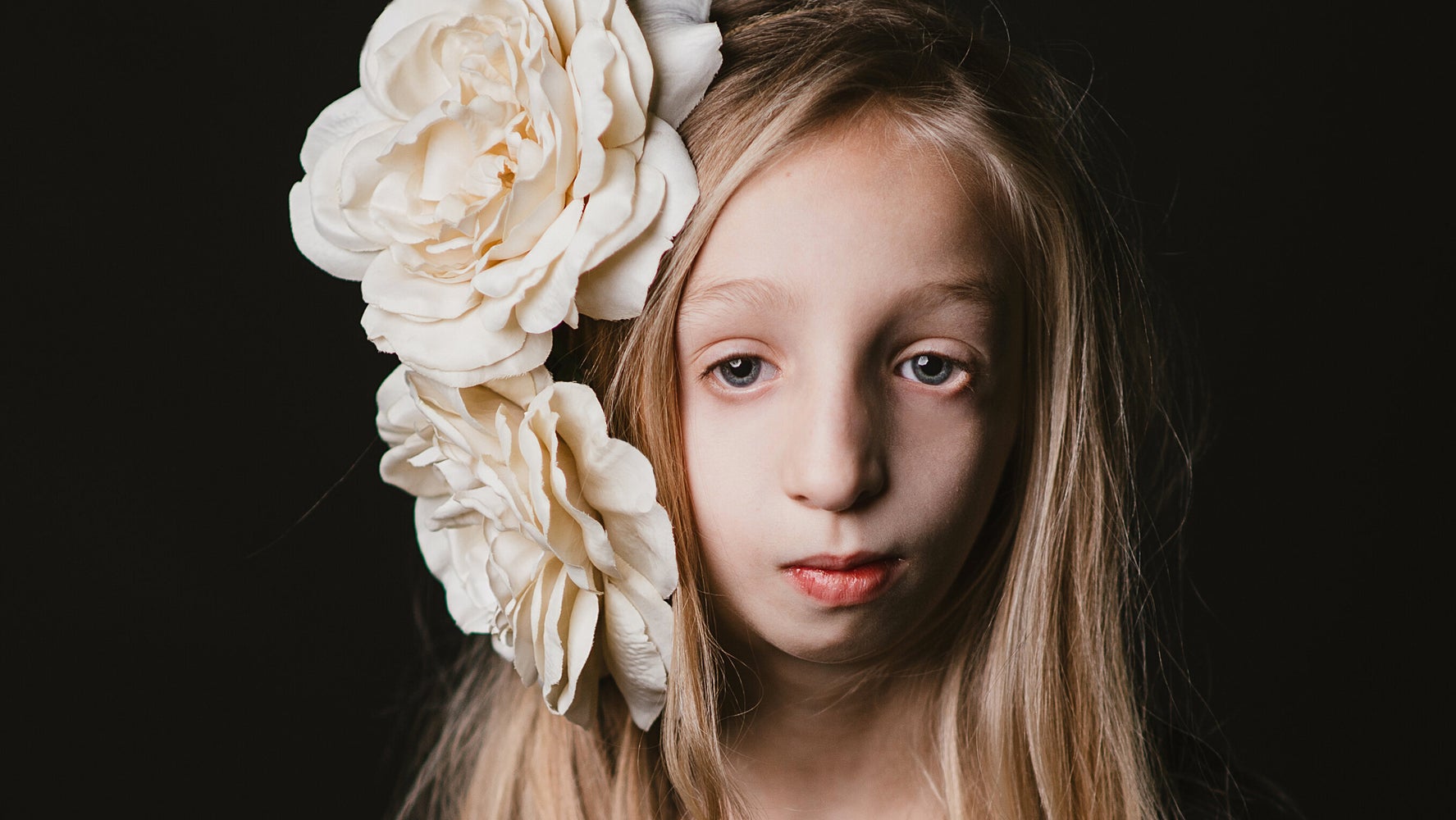 Syndrome De Treacher Collins Espérance De Vie