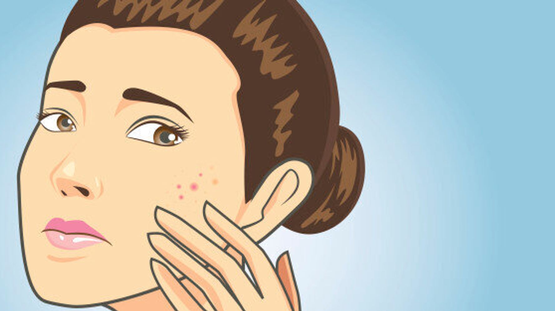 If You Really Have to Squeeze That Pimple, Here's How | HuffPost ...