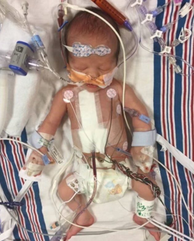 William "Billy" Kimmel was born with a congenital heart condition.