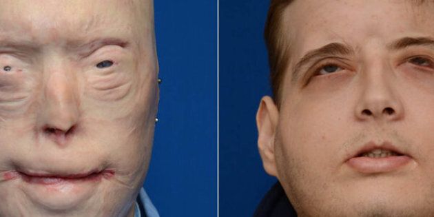 Patrick Hardison prior to his face transplant surgery (left) and in February 2016, about six months after surgery.