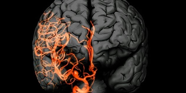 Brain aneurysm. 3D computed tomography (CT) angiogram coupled with a magnetic resonance imaging (MRI) scan of the brain of a 38-year-old, showing a large aneurysm (bright, lower centre) of the right internal carotid artery. An aneurysm is the ballooning of an artery due to weakening of the artery wall.