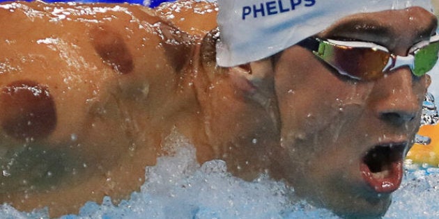 Michael Phelps competes at the Rio Olympics with circular bruises from cupping on his shoulders and back.