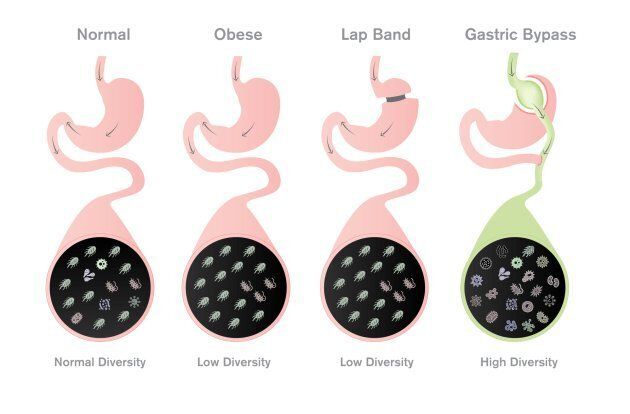 Obese people generally have lower levels of diversity in their gut bacteria, yet the study showed more microbial diversity in people who'd had gastric bypass surgery even than a healthy-weight individual.