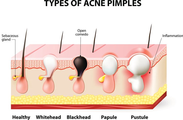 Types of acne pimples.