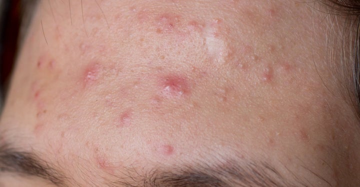 Papules, the type of acne this procedure treats.