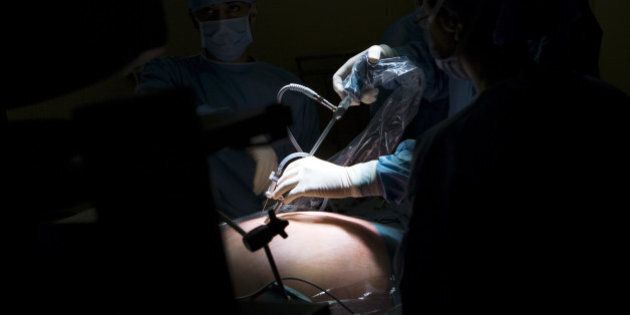 Photo Essay At The Hospital Of Meaux 77, France. Visceral And Digestive Surgery. Surgery Of Obesity Sleeve Gastrectomy Under Laparoscopy. (Photo By BSIP/UIG Via Getty Images)