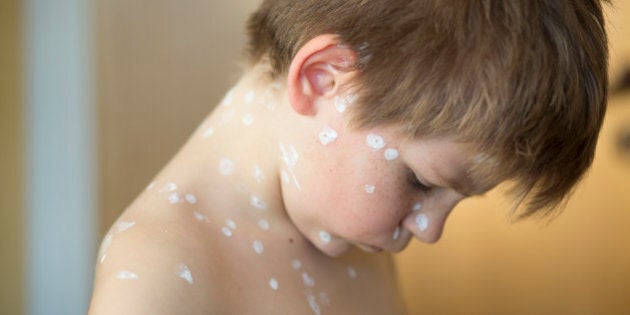 chicken pox