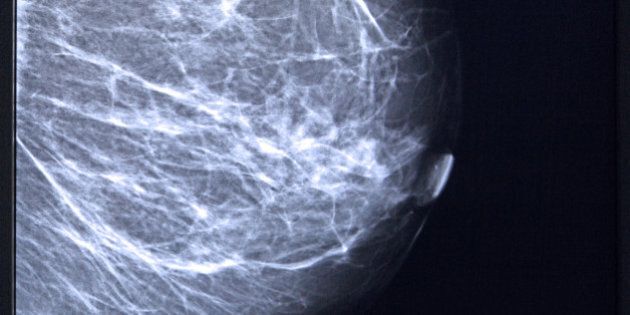 Mammogram of female breast