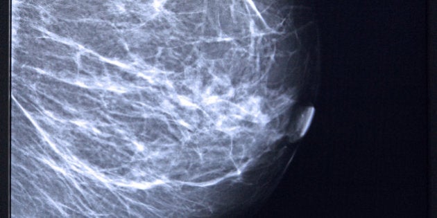 Mammogram of female breast