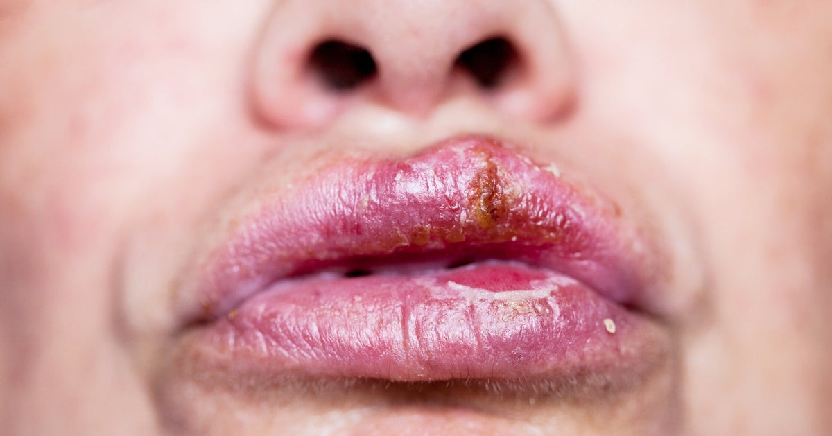 Everything You Need To Know About Herpes | HuffPost Health