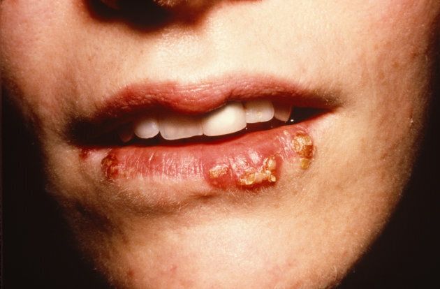 Herpes simplex type one hangs around the mouth, like this, while type two in the genitals.