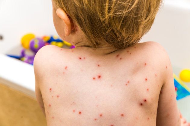 Human herpes virus three causes chickenpox in children and is also the cause of Shingles.
