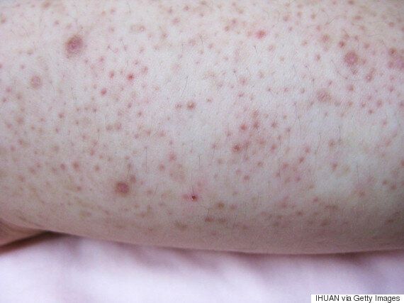 Red Bumps On The Back Of Your Arms How To Treat Keratosis Pilaris Huffpost Latest News
