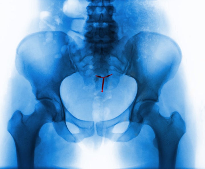 X-Ray of an intrauterine device.