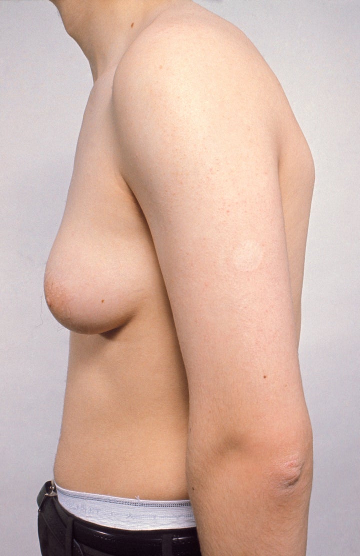 An example of gynaecomastia in a 17 year old male.