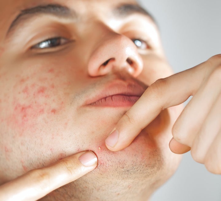 Acne is the most common of skin diseases, affecting 85 percent of Australians aged 15-24 years old.