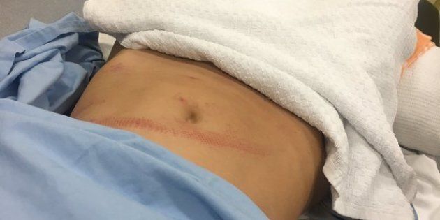 Jockey Michelle Payne tweeted a picture of her injured abdomen, pointing out this happened through a protective vest.