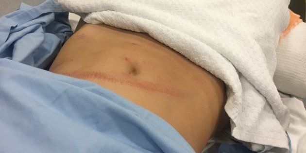 Payne tweeted this picture of her injured abdomen.