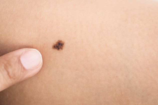If you notice a new mole, or changes to an existing one, you should get it checked by a doctor immediately.