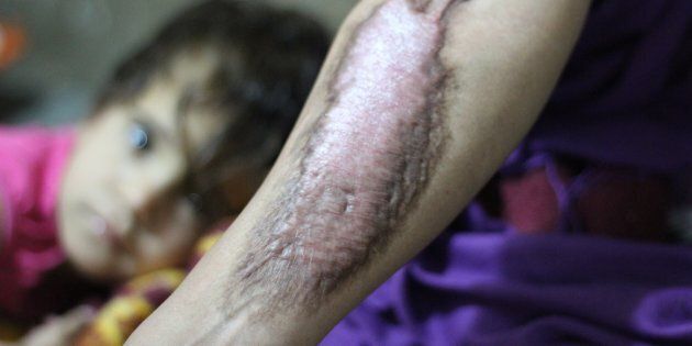 A woman shows her scars and burns months after she was scalded by a mustard agent that ISIS launched in the town of Taza, Iraq, in March.