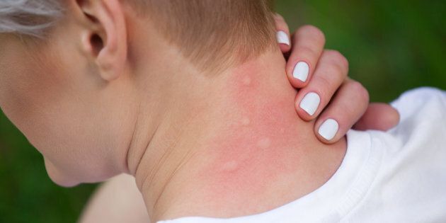 A mosquito bite could leave more than an itchy spot.