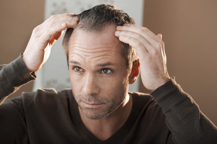 In men, hair loss is often first noticeable around the temples.