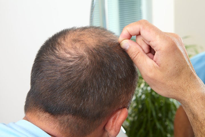 The other place men might initially notice hair loss is at the back of their head.