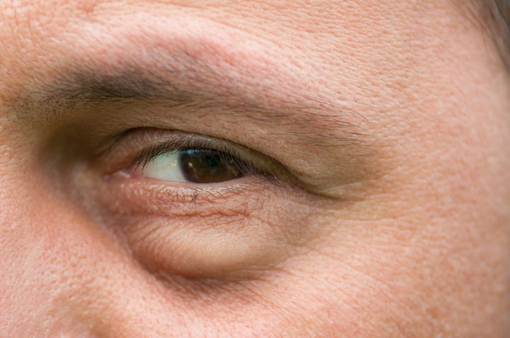 Eye bags can become weaker or can pop out with age.